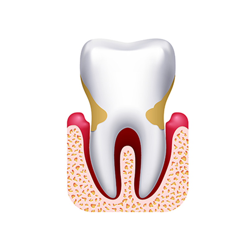 3D illustration of a tooth with mild periodontitis..